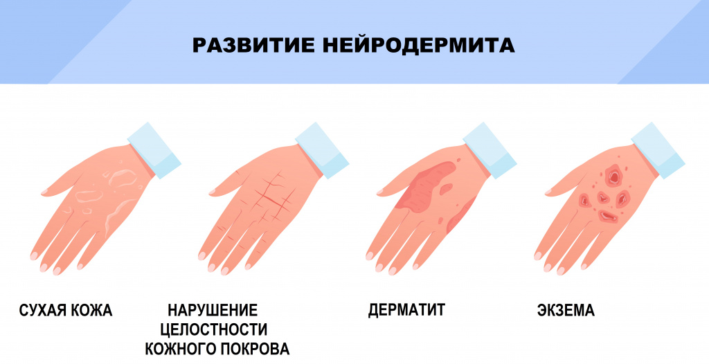 Нейродермит: понимание, лечение и забота о здоровье кожи | Советы по профилактике и уходу | Многопрофильный медицинский центр Воронеж